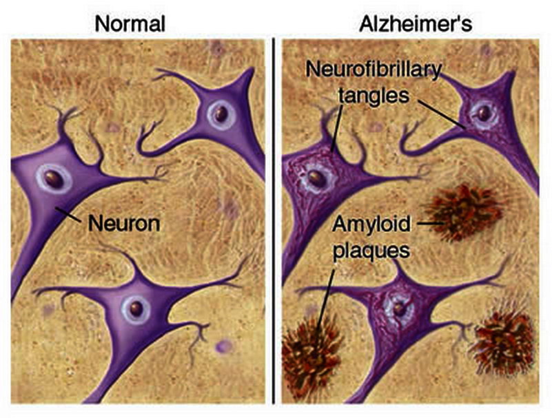 Qvision Diagnóstico precoz del Alzheimer‏ placas y neuronas